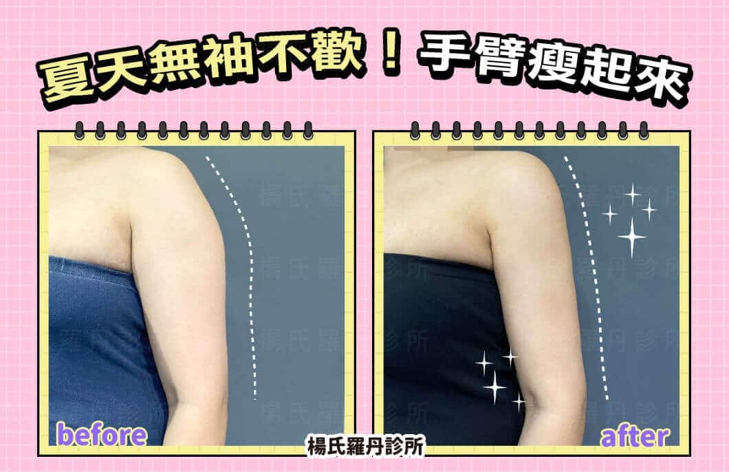 【雷射減脂】夏天無袖不歡！手臂瘦起來～